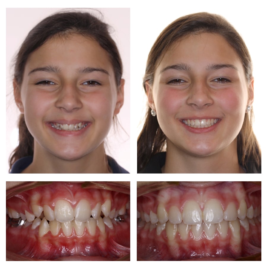 Grace Campbell-Before and After