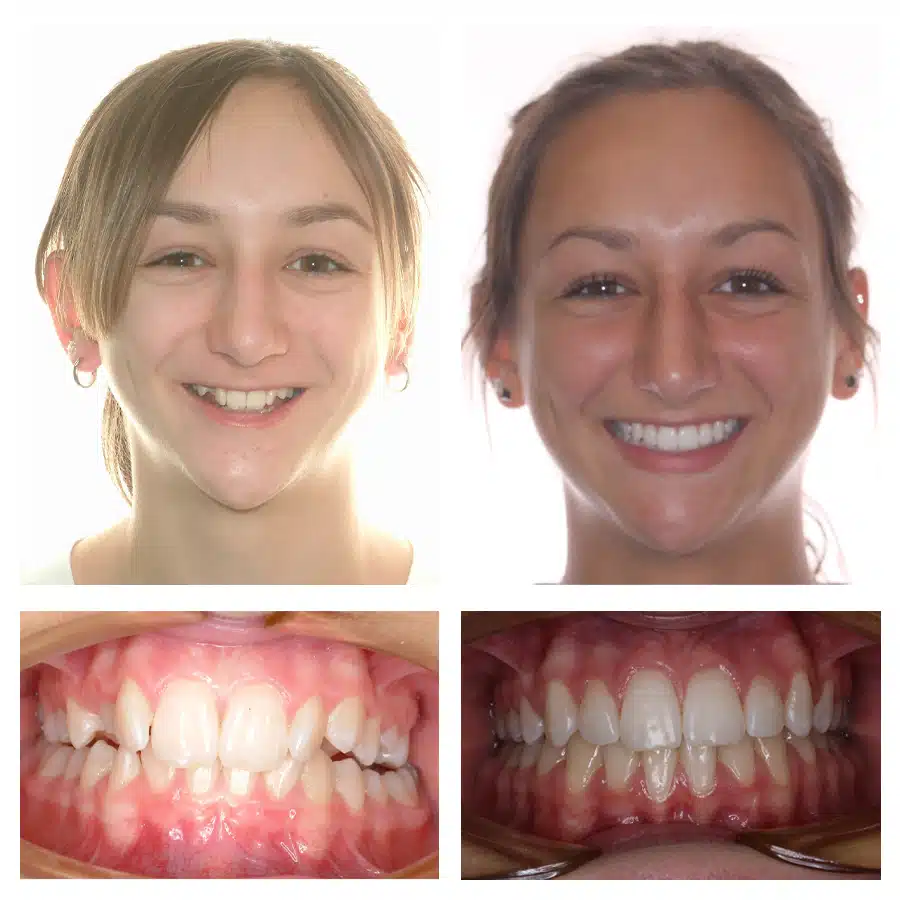 Cayla Holtz Before and After