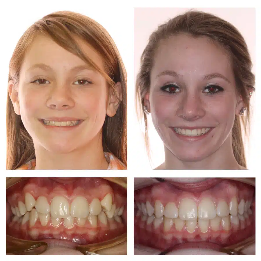 Emma Anderson Before and After