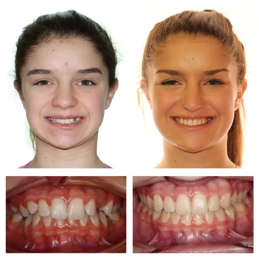 Gabriella Frangopoulos Before and After