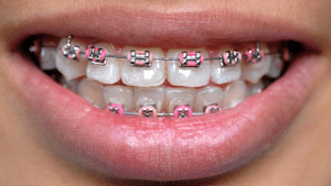Metal Braces