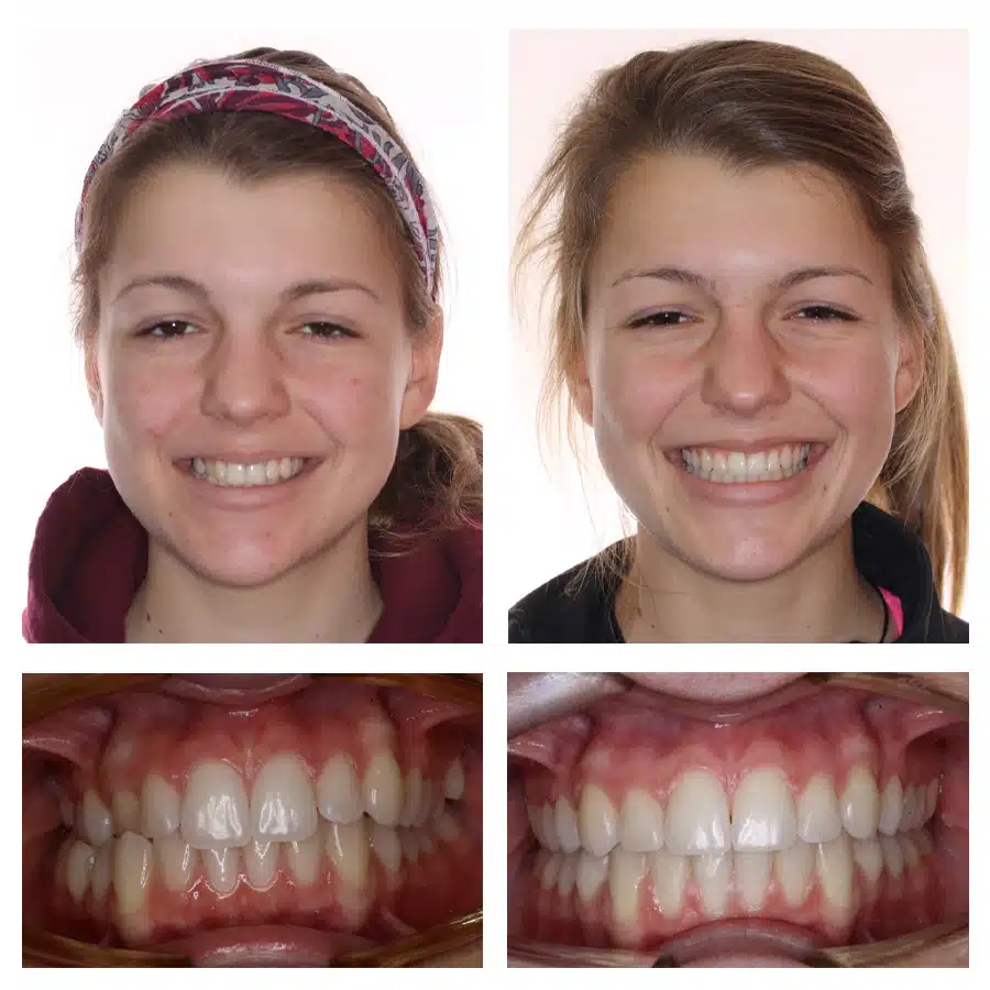 Rachel Misna Before and After
